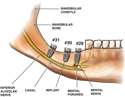 Implants impining on mandibular canal